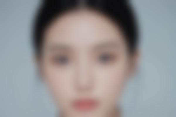 河北邯郸曲胜医生整形修复，眼部鼻部面部轮廓综合打造自然美！