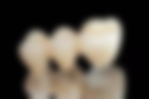 二十岁了还可以牙齿矫正吗？从个人需求看可行性