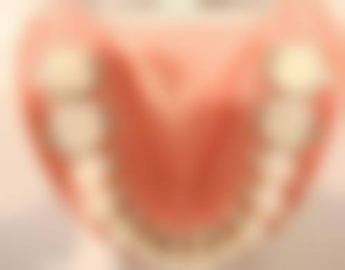 了解烤瓷牙修复缺四颗牙的过程和优缺点