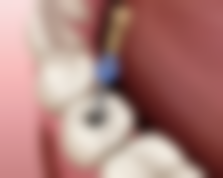 钛合金烤瓷牙和钴铬烤瓷牙哪个好？各有千秋，需结合美观需求、生物相容性及价格等因素选！ 