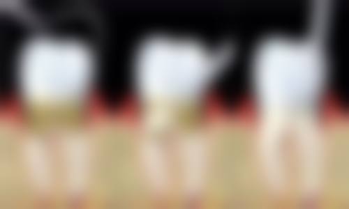 洗牙扁桃体结石怎么去除？洗牙无法去除，可通过漱口、器械处理、手术等方式来搞定！ 