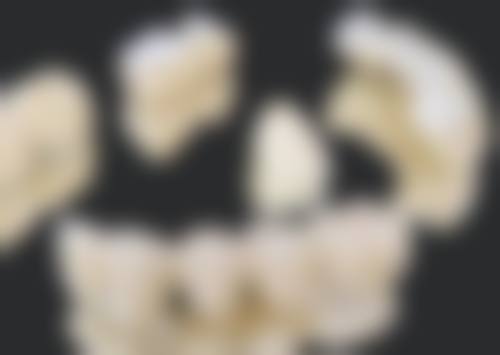 快速牙齿矫正多少岁合适？一般12 - 18岁佳，但不同畸形矫正时间有别，无年龄限制！ 