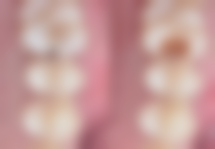 国产陶瓷种植牙品牌