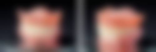 全瓷牙：美观与健康的优选