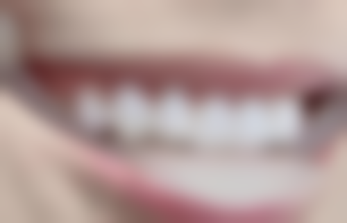 美观成效：种植牙与自然牙齿无差别