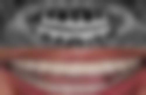 烤瓷牙的牙龈发炎怎么办？别慌，了解原因与治疗方式，做好日常护理可有效应对！ 