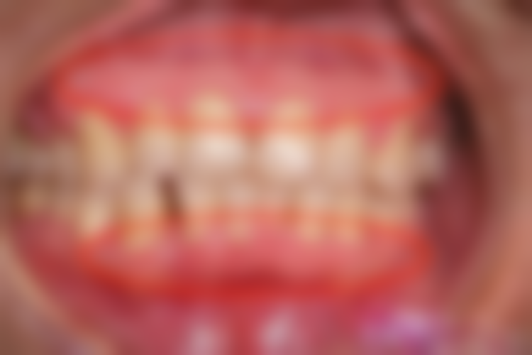 小孩感冒期间能拔牙吗？一般不建议，特殊情况需评估，康复2 - 3周拔牙更稳妥！ 