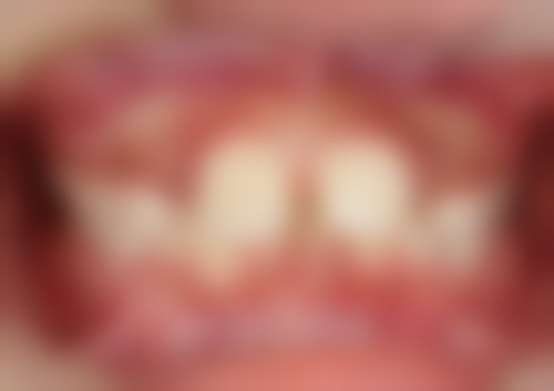 拔牙可以在经期拔牙吗？一般不建议，特殊急症可考虑，建议避开经期治疗！ 