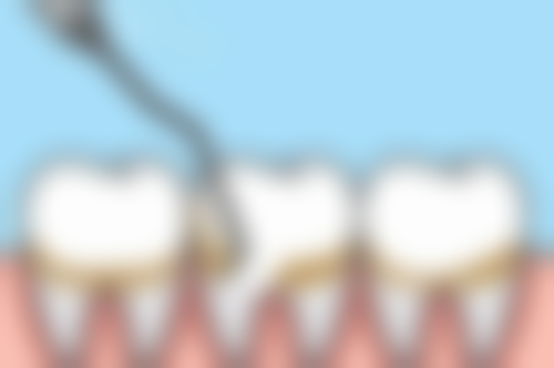 洗牙的原理和作用