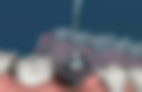 五、广东揭阳普宁流沙黄仕娜口腔收费价格表