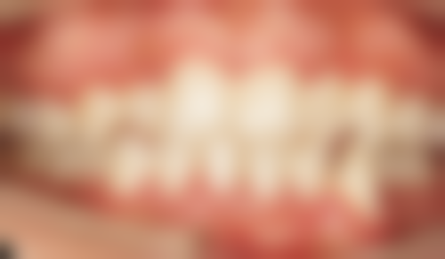 做过开颅手术的人能拔牙吗？需分癫痫、老人、脑瘤等情况，综合评估后由医生判断！ 