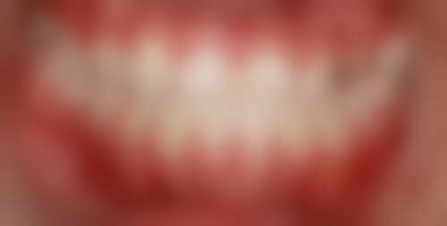 安装假牙需要拔牙根吗?这得看牙根状况，健康稳固或可保留，受损感染可能要拔除！ 