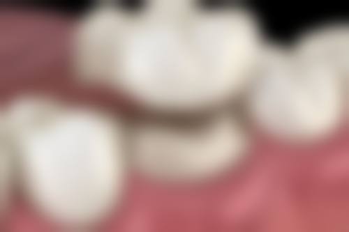 影响贴面牙使用寿命的因素