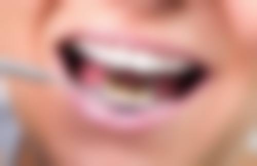 牙齿美白瓷贴面有什么弊端？可能存在敏感、咬合问题、感染等，成本维护也需考量！ 