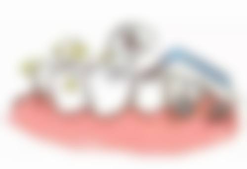 根管治疗为啥要打桩？——修复牙体外形