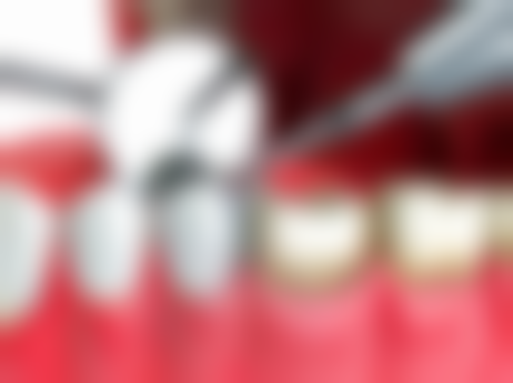 拔牙后吃雪糕会感染吗？不一定，掌握食用时机、方式和注意口腔卫生可降低感染风险！ 