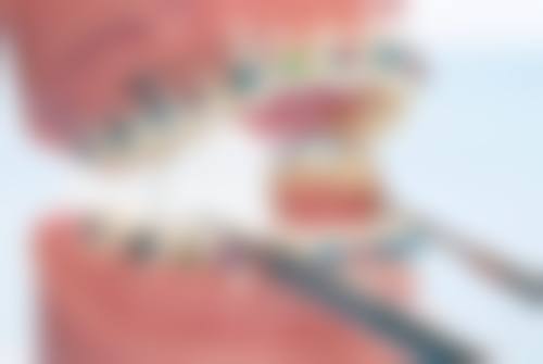 牙龈萎缩对装全瓷牙的影响