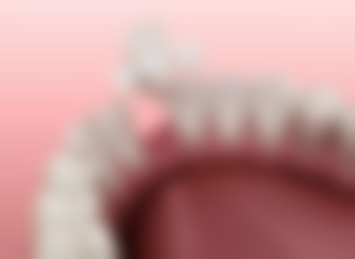 中度损伤：瓷贴面修复