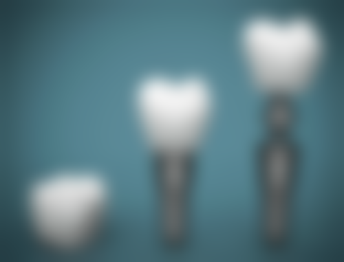 牙冠材料：多样选择满足不同需求