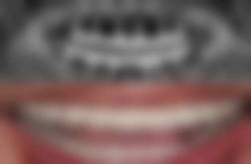 可以一边拔牙一边根管吗？不同医生观点不一，需考量创伤、恢复、疼痛及患者状况再决定！ 