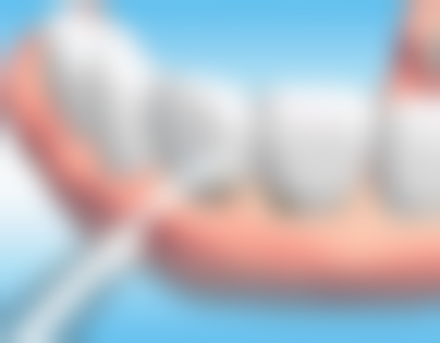 口腔护理情况决定牙根管治疗牙齿的寿命