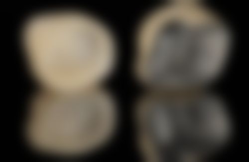 不可吸收线与拆线的必要性