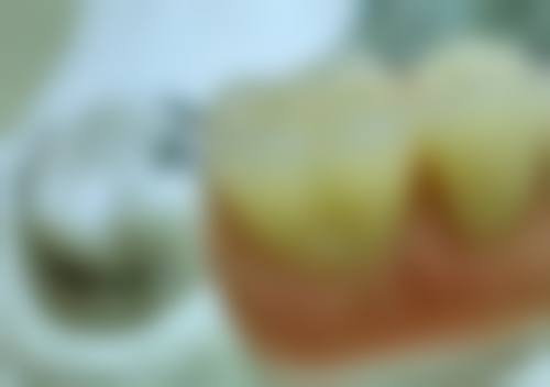 治疗类型影响补牙安排