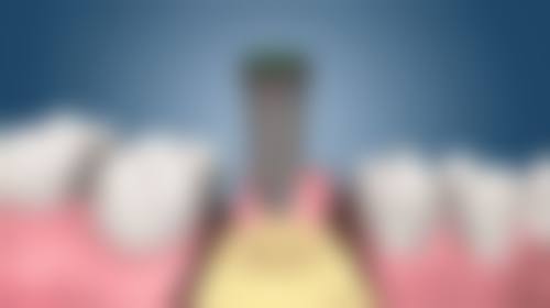 拔牙后两个月可以种植牙吗？部分情况可行，但要考虑牙龈、牙槽骨状况及炎症等因素！ 