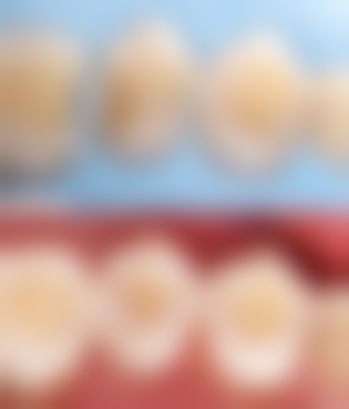 不同程度龋坏的表现及影响