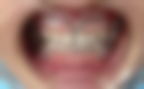 牙齿矫正什么年纪合适？乳牙期到成年各有适配阶段，青少年黄金期效果优、周期短！ 