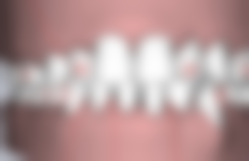 根管治疗是怎么回事