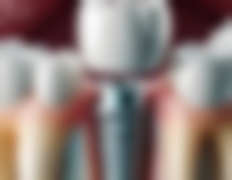 戴牙齿矫正器改变脸型的注意事项