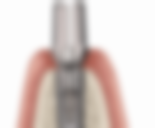 五、德阳口腔杨华医生技术怎么样?