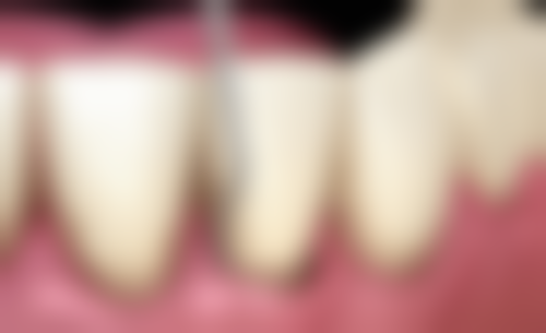 小孩蛀牙做根管治疗过程中疼不疼