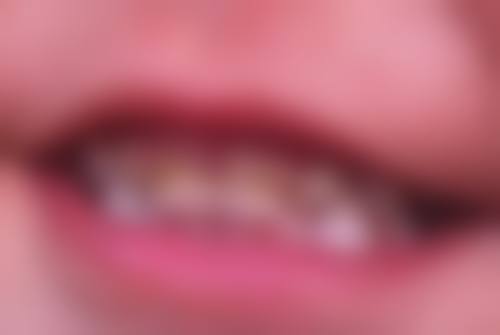 久未缓解的疼痛需警惕根管治疗失败