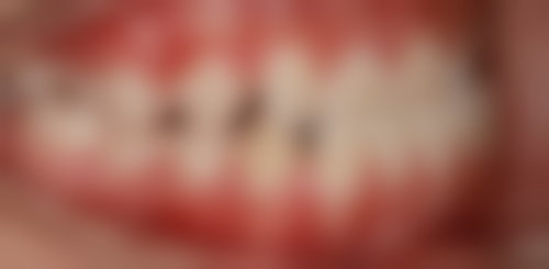 不同年龄段做烤瓷牙的至佳时间