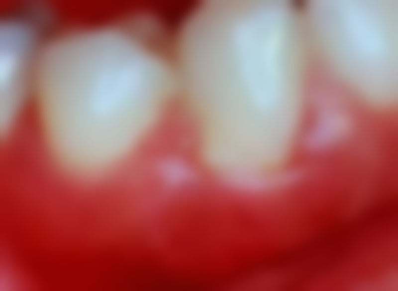 避开不宜拔牙的情况