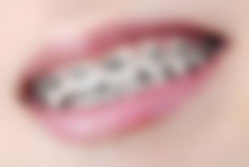 一次完成根管治疗可降低感染风险