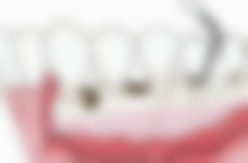 固定活动义齿和活动活动义齿哪个好？从多维度对比优劣，结合自身情况才能选出更适合的！ 