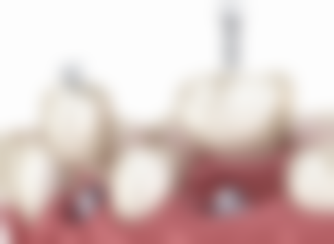 牙齿松动可以做烤瓷牙套吗？需结合松动程度与病因判断，建议先治疗再评估！ 