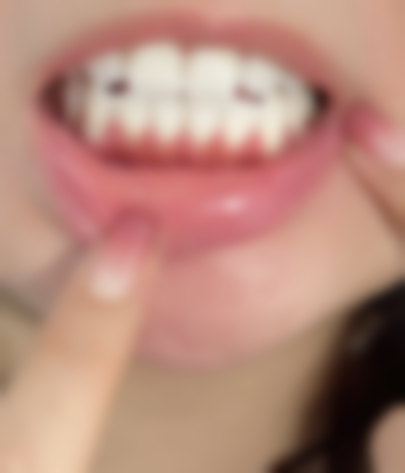 种植牙带来的牙龈问题