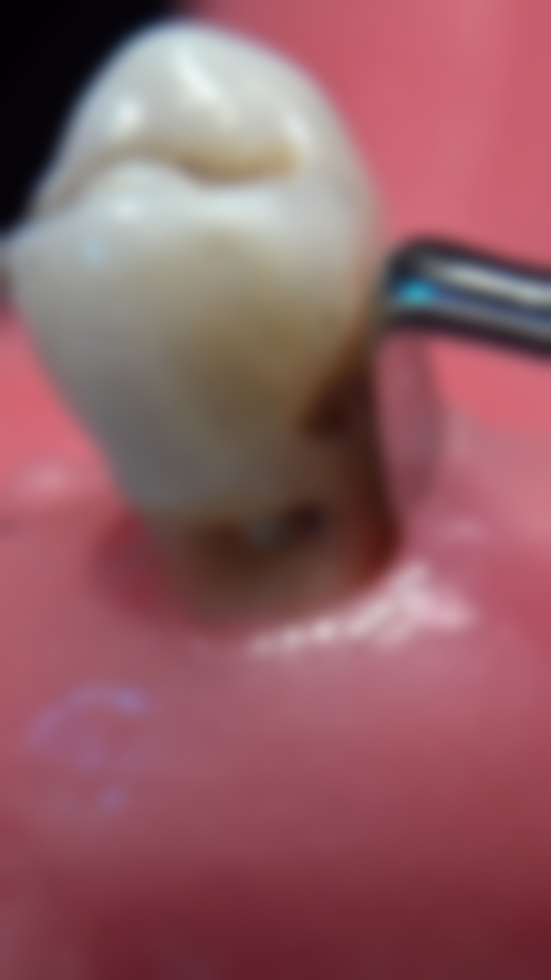 怀孕能不能做烤瓷牙？多数情况不建议，因孕期风险多，特殊情况需多科医生联合评估！ 