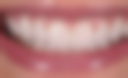 牙齿矫正的技术方案