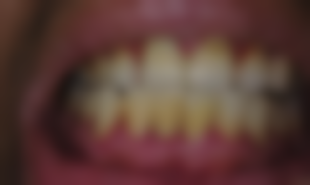 降低洗牙风险的建议