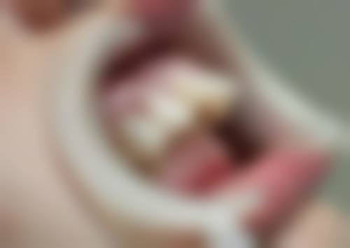 牙齿松动的真正原因