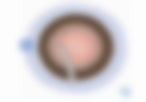 准分子激光-标准化TransPRK:微创效率高的近视矫正方案