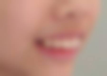 临床实例分享北京瑞城口腔医院张桂新